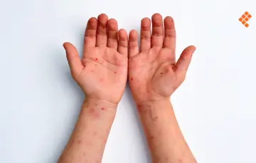 Acumula Tabasco 73 casos de sarampión en 2026; reportan 406 probables