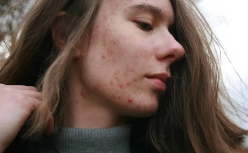 Reconocen rosácea como enfermedad inflamatoria crónica