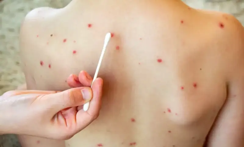 Suman 34 casos de sarampión en Querétaro en 2026