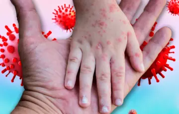 Se disparan casos de Herpes Zóster en Tabasco este 2026