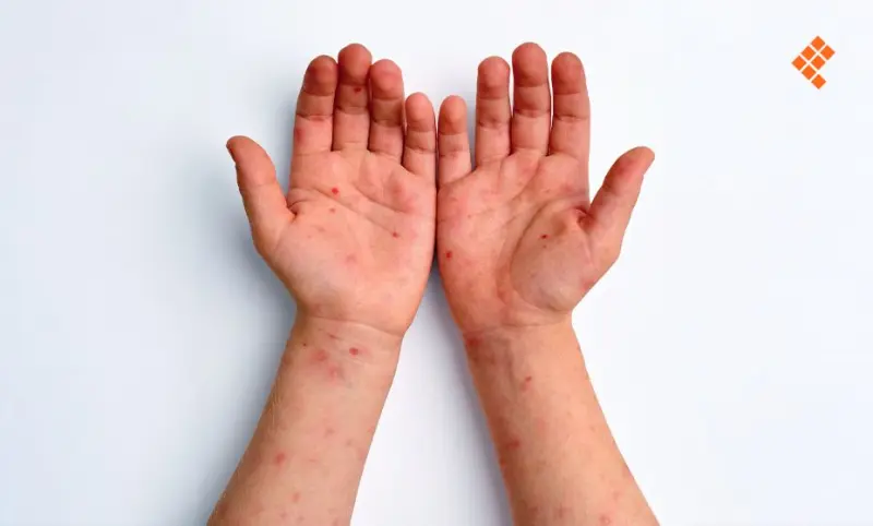 Confirman caso 17 de sarampión en Morelos