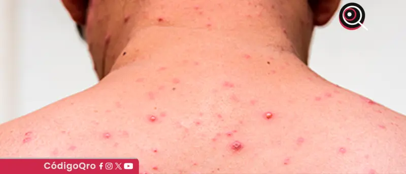 Reportan 30 casos confirmados de sarampión en Querétaro