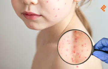 Morelia, con vigilancia epidemiológica por caso de sarampión