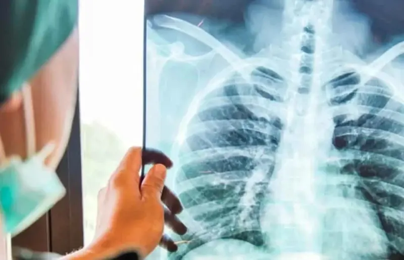 Falta de vacunación y hacinamiento, principales causas del contagio de tuberculosis