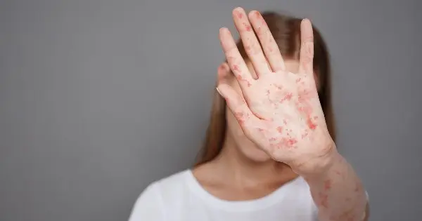 Suman 43 casos de sarampión en Querétaro en 2026