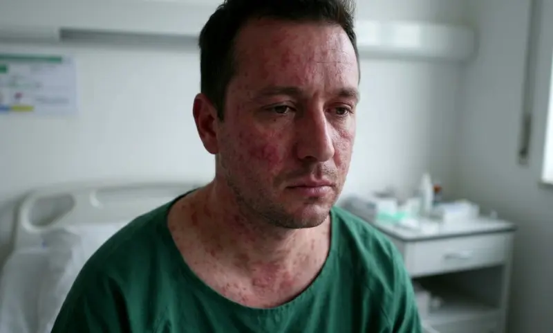 Casos de sarampión en Nuevo León suman ya 52; se registran tres en los primeros días de abril