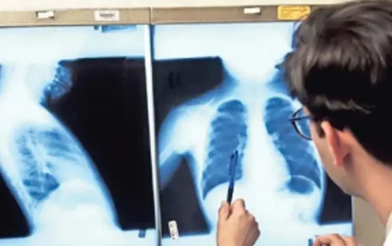 Acumula Chihuahua 27 muertes por tuberculosis