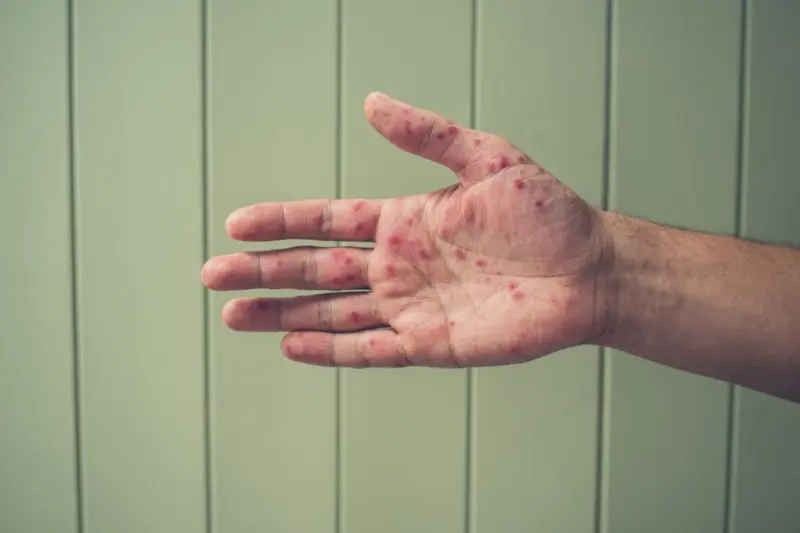 Confirman dos nuevos casos de sarampión en Querétaro; suman 43 en 2026