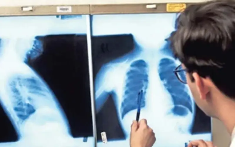 Suman 53 muertes por tuberculosis en el estado