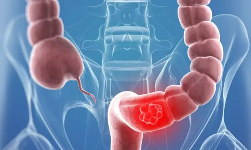 Las nuevas guías de la Sociedad Americana contra el Cáncer explican cómo detectar el cáncer de colon mediante una prueba de sangre alternativa, un método que eleva la sobrevida al 90% si es oportuno