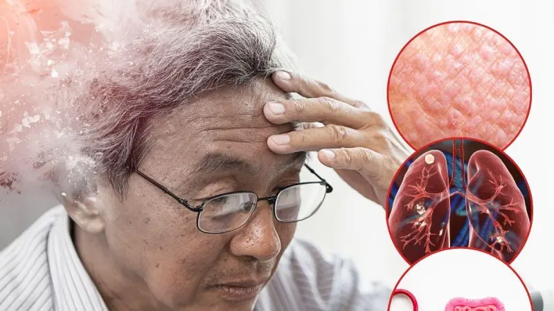 Alzheimer: inflamación en piel, pulmones e intestino podría estar relacionada
