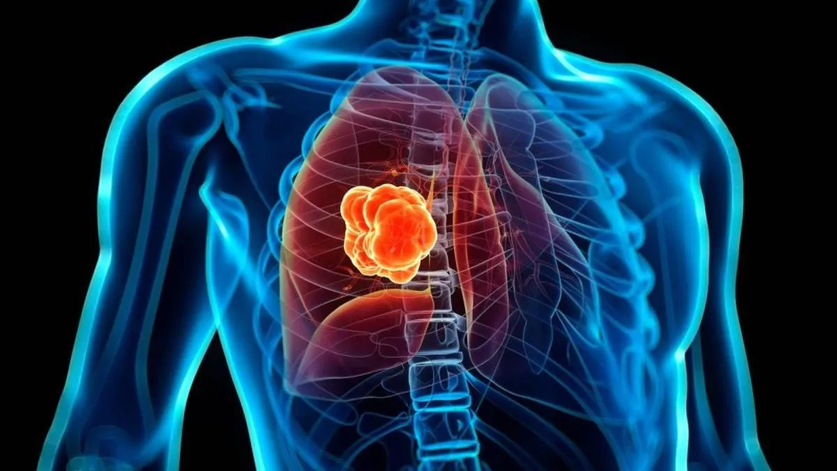 Roche crea fármaco experimental contra el cáncer de pulmón que redujo riesgo de muerte en 44%