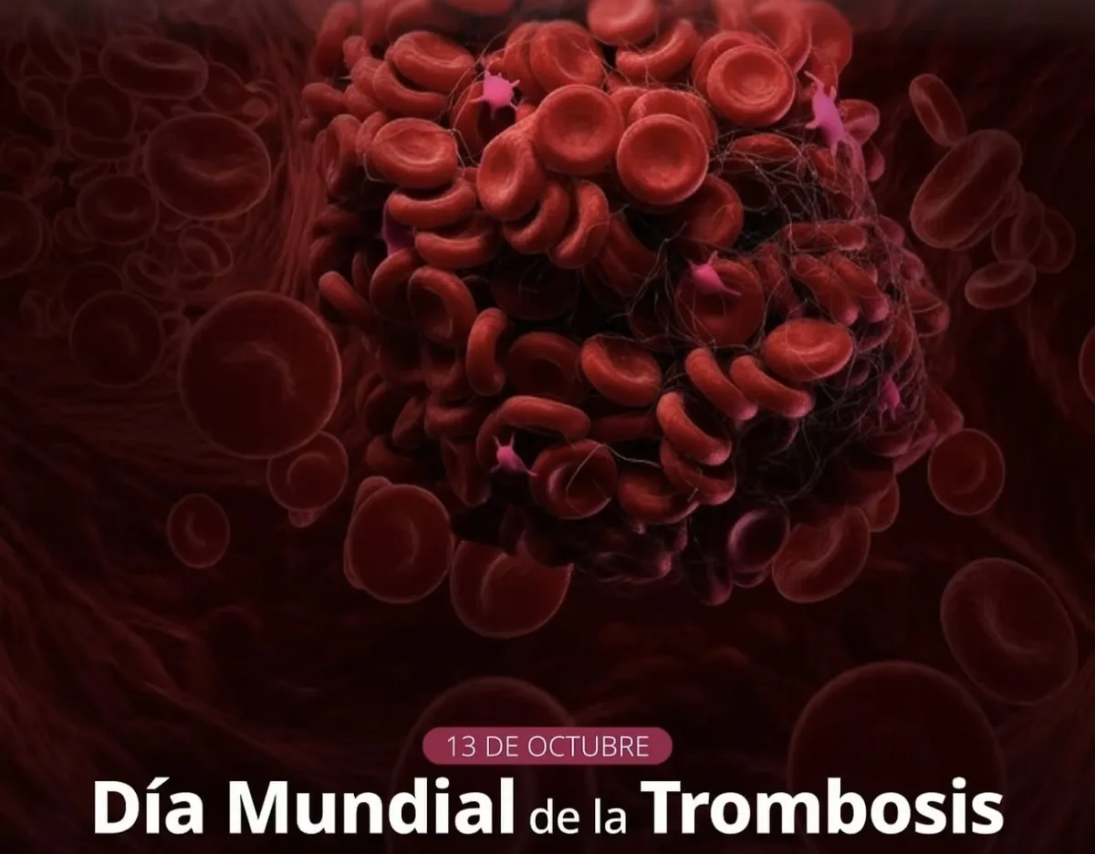 Alertan sobre riesgos de trombosis; llaman a prevenir coágulos sanguíneos