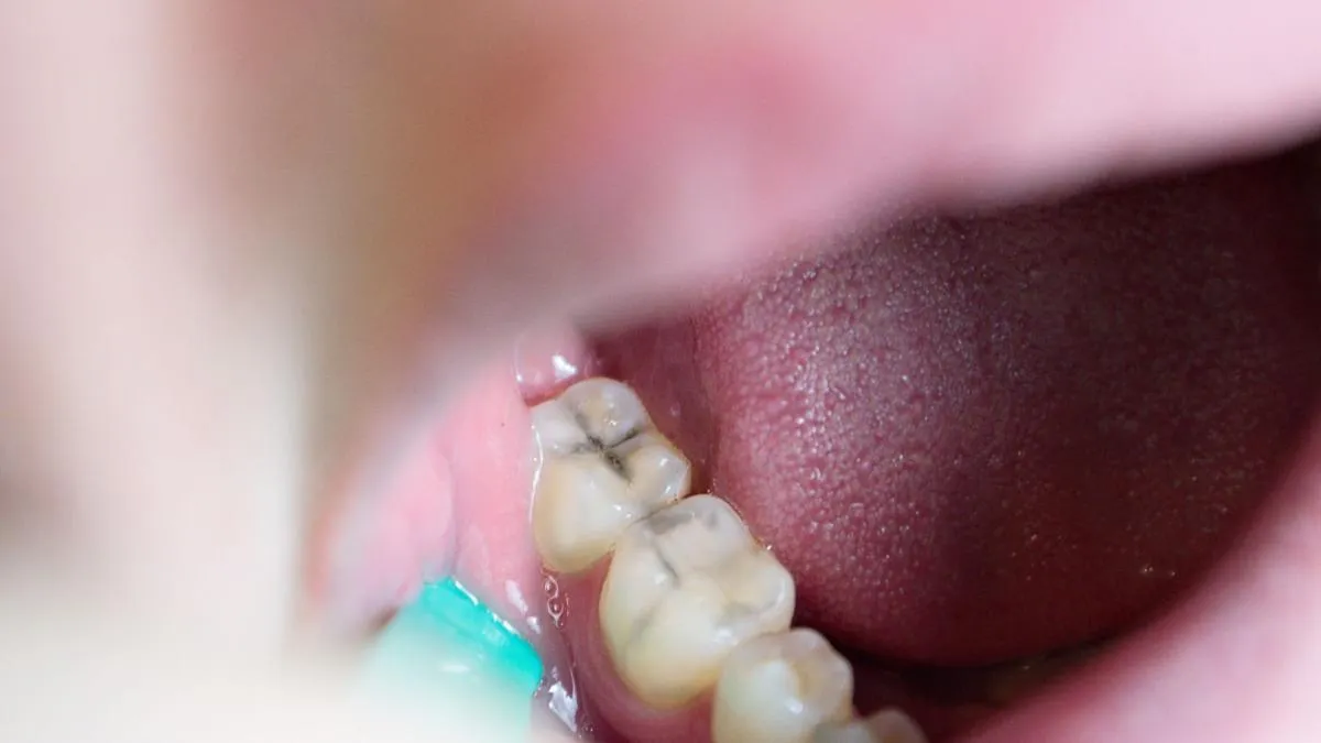 ¿Odias el sonido de la fresa? Un líquido puede frenar las caries sin perforar los dientes