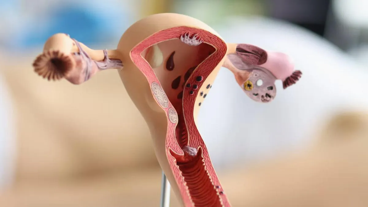 Endometriosis: cuando controlar las hormonas no basta para frenar el dolor