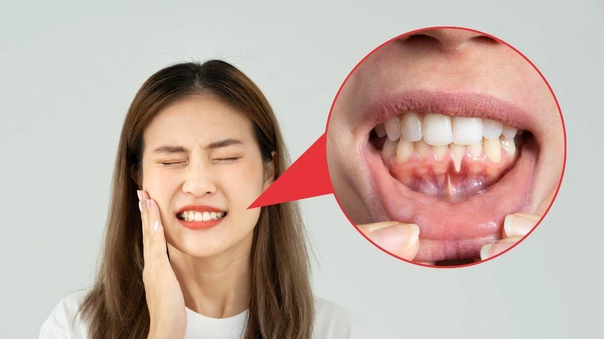 ¿Tus dientes se ven más largos? Puede tratarse de recesión gingival