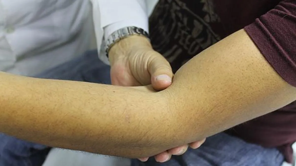 ¿Vivir con hemofilia? Pacientes adaptan su vida al tratamiento; esta es la razón
