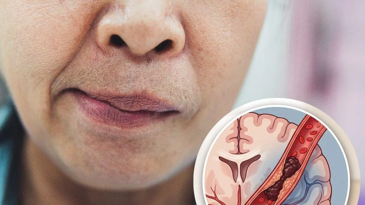 Trombólisis intravenosa y trombectomía: tratamientos para un ACV isquémico
