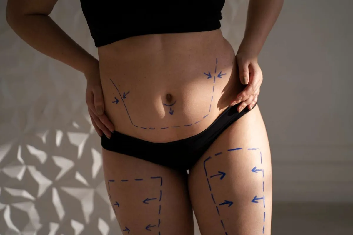 Liposucción: lo que hace, lo que no hace y para quién está indicada